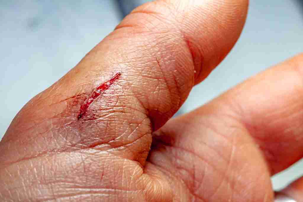 Photo of a fresh cut on a finger